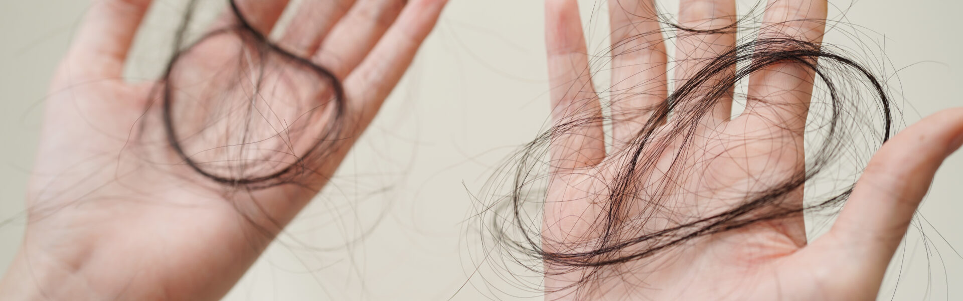 Przedstawione zdjęcie ukazuje dłonie kobiety, która trzyma wypadające włosy z głowy. Włosy są cienkie i rzadkie, co może sugerować problem z ich wypadaniem. Kolor skóry na zdjęciu wskazuje, że dłonie należą do kobiety o jasnej karnacji